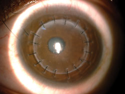 Figure 4. Deep anterior lamellar keratoplasty postop.