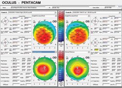 Figure 1. Pentacam corneal front curvature (axial or sagittal) maps in both eyes.