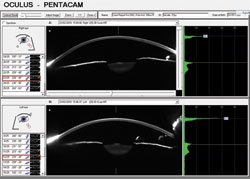 Figure 2. Scheimpflug images of both eyes.