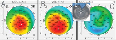 Figure 4. After Keraring implantation (a), preop (b), subtraction map (c) and tomogram based on Scheimpflug images identifying the intracorneal ring segments (d).