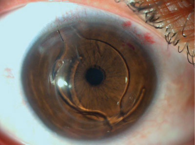 Figure 5. Slit lamp image taken 4 hours after phakic IOL implantation.