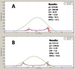 Figure 6. ORA signal and metrics 4 hours after phakic IOL implantation before (a) and after (b) paracentesis opening for draining aqueous humor.