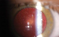 Figure 1. Retroillumination of the left eye highlights a central posterior subcapsular cataract. Cortical opacities are also present. Both of these findings were present bilaterally.