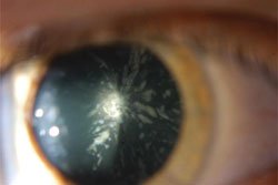 Figure 1. Retroillumination of the left eye highlights a central posterior subcapsular cataract. Cortical opacities are also present. Both of these findings were present bilaterally.