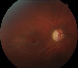 Figure 2. Bilateral optic atrophy with temporal pallor. No pigmentary retinopathy was noted in either eye.