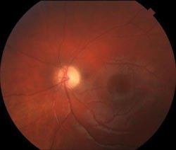 Figure 2. Bilateral optic atrophy with temporal pallor. No pigmentary retinopathy was noted in either eye.