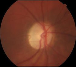 Figure 2. Bilateral optic atrophy with temporal pallor. No pigmentary retinopathy was noted in either eye.