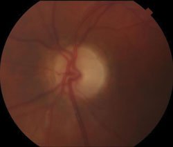 Figure 2. Bilateral optic atrophy with temporal pallor. No pigmentary retinopathy was noted in either eye.