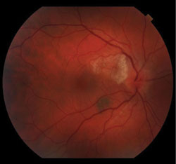 Figure 1. Fundus photography showing a swollen, hyperemic right optic nerve with a white lesion extending from the superotemporal aspect of the right optic nerve. There is a benign nevus by the left inferior arcade. The left eye is unremarkable.