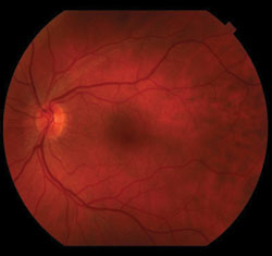 Figure 1. Fundus photography showing a swollen, hyperemic right optic nerve with a white lesion extending from the superotemporal aspect of the right optic nerve. There is a benign nevus by the left inferior arcade. The left eye is unremarkable.