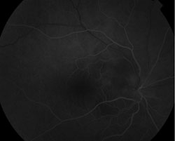 Figure 2. Fluorescein angiography demonstrating leakage of the right optic nerve without evidence of vasculitis.