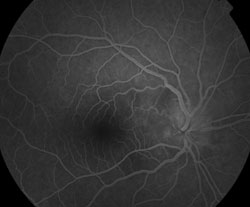 Figure 2. Fluorescein angiography demonstrating leakage of the right optic nerve without evidence of vasculitis.