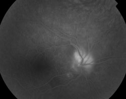 Figure 2. Fluorescein angiography demonstrating leakage of the right optic nerve without evidence of vasculitis.