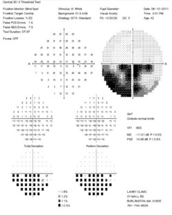 Figure 3. Humphrey 30-2 visual field tests demonstrating a right inferior altitudinal defect. 