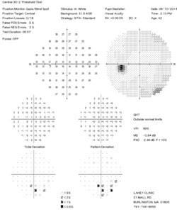 Figure 3. Humphrey 30-2 visual field tests demonstrating a right inferior altitudinal defect. 