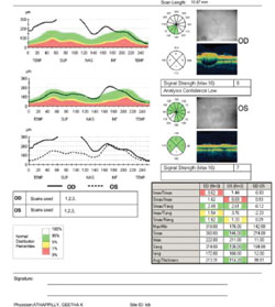 Figure 4. OCT revealing increased retinal nerve fiber layer of the right optic nerve. 