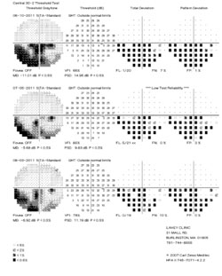 Figure 5. Humphrey 30-2 visual fields demonstrating gradual improvement of the right inferior altitudinal field defect. Left visual field is within normal limits. 