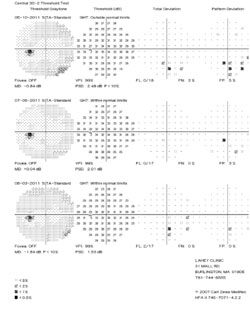 Figure 5. Humphrey 30-2 visual fields demonstrating gradual improvement of the right inferior altitudinal field defect. Left visual field is within normal limits. 