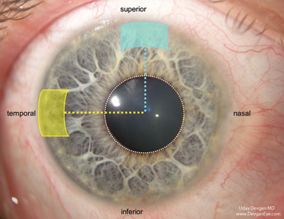 Figure 1. Due to the natural asymmetry of the eye, the superior limbus (blue) is closer to the central visual axis than the temporal limbus (yellow) and has more of an astigmatic effect given the same size incision.