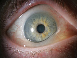 Figure 1. Conjunctivochalasis of the right eye.