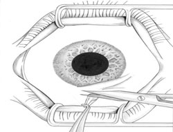 Figure 2. Tenting of the conjunctiva before an incisional biopsy with Westcott scissors.