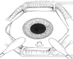 Figure 3. Cotton swab-assisted expression of subconjunctival fluid.