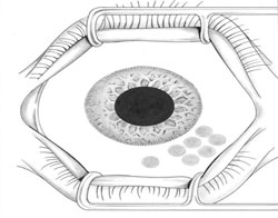 Figure 5. Multiple areas of cryotherapy applied over the bulbar conjunctiva.