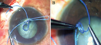 Figure 1.  (A) The glued endocapsular hemi-ring segment. (B) Double scrolls of the device that engage the rhexis rim in an atraumatic manner.