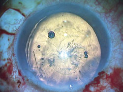 Figure 2. Scleral flap made at the area of the subluxation.