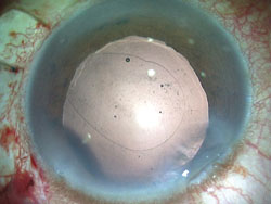 Figure 4. Glued endocapsular ring in place.