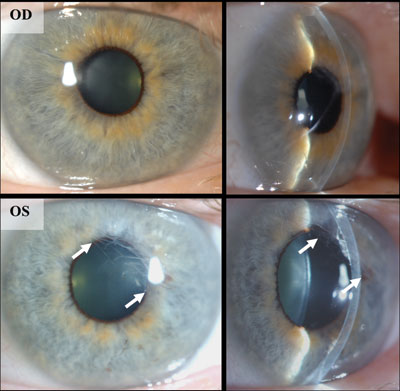 Slit-lamp photographs of a cornea 6  months after initial DMEK (top), and 1 month after secondary DSEK (bottom). 