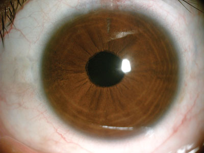 Postop glued IOL. Note the scleral flaps and the blue  haptics tucked and glued in the sclera.