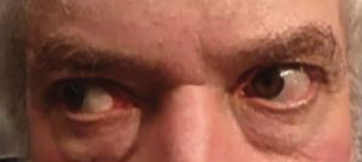 Figure 2. Lateral gaze to the right and left. 