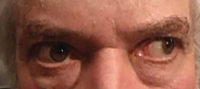 Figure 2. Lateral gaze to the right and left. 