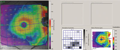 The macular thickness results showed that the extent of loss from glaucoma was minimal in the right eye providing reassurance in a monocular patient.