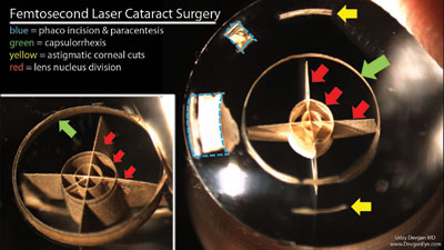 Figure 1. The femtosecond laser treatment for cataract surgery is shown in this plastic polymer. 