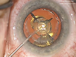 Figure 2. Intraoperative view of femtosecond laser incisions in cataract surgery.