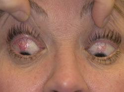 Figure 1. Superior limbic keratoconjunctivitis (Patient 2, Table).