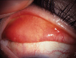 Figure 2. Fine papillary reaction on palpebral conjunctiva in SLK (Patient 4, Table).