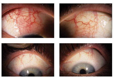 Figure 3. Superior bulbar conjunctiva in a patient with SLK before and 1 year after cryotherapy (Patient 2, Table).