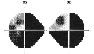 Visual field analysis on 4/8/11 revealing worsening visual fields.