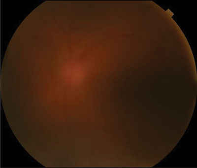 Figure 1a. Color fundus photograph of the left eye demonstrates vitritis as well as flame hemorrhages.