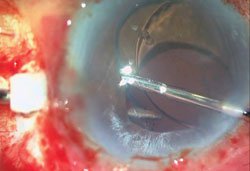 Figure 2a. Posterior chamber IOL implanted in anterior chamber leading to corneal decompensation. 