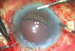 Figure 2b. The haptic is exteriorized through the sclerotomy made under the scleral flap.