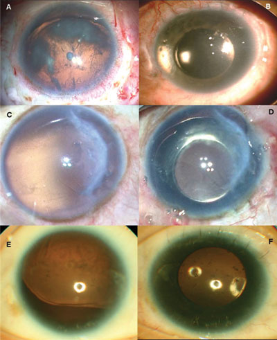 Preoperative image of congenital aniridia with subluxated cataract (a). Postoperative outcome (b). Traumatic aniridia with aphakia (c). Postoperative image (d). Congenital aniridia with subluxated lens (e). Postoperative image of the same patient (f). 