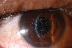 Figure 1a. Photograph of the right and left eye. Central gray-white opacities are visible in the anterior to mid-stroma. 