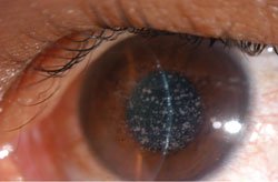 Figure 1b. Photograph of the right and left eye. Central gray-white opacities are visible in the anterior to mid-stroma. 