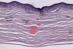 Figure 2. Pathology section of cornea with eosinophilic hyaline deposits in the anterior to mid-stroma.