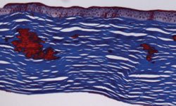 Figure 3. Pathology section of cornea with positive red staining with Masson trichrome.