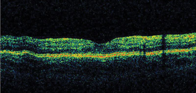 Figure 1a. OCT of the right eye. 